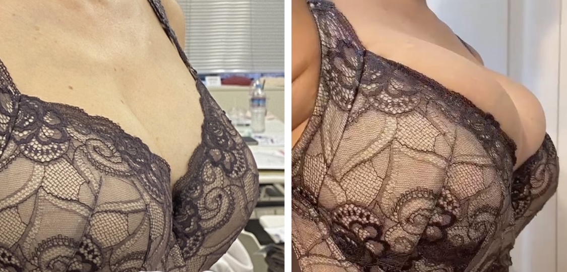 Asami - teamMEDEL育乳部 - DMMオンラインサロン